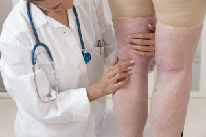 spider veins vs varicose veins